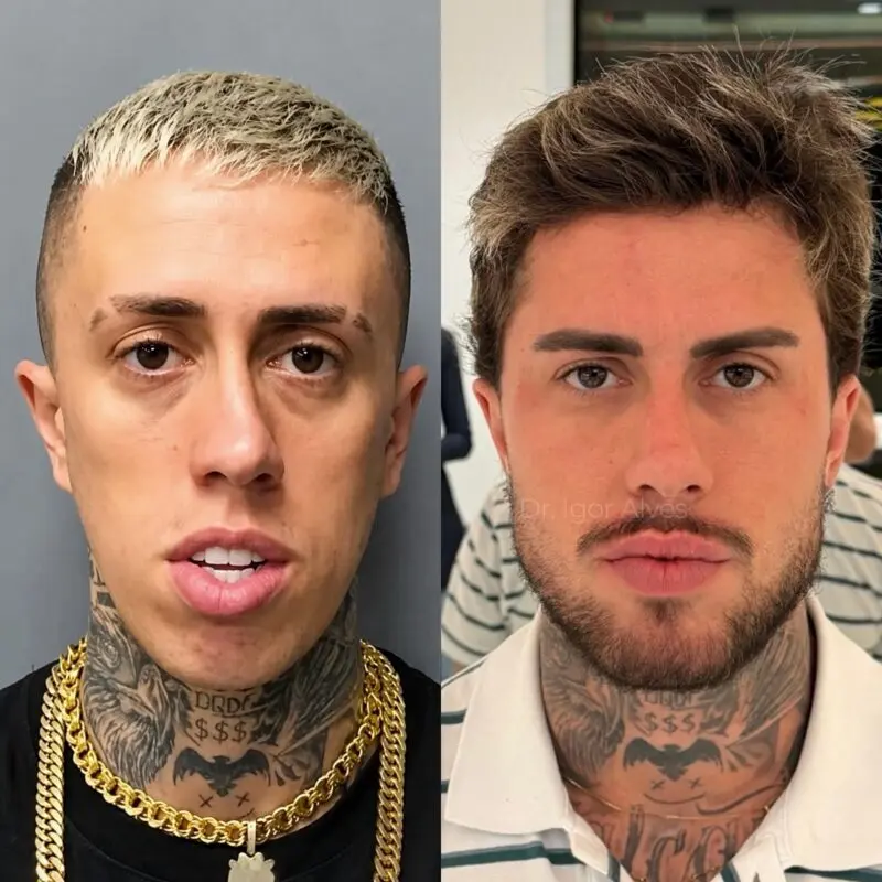 MC Daniel mostra antes e depois de procedimentos estéticos e novo rosto impressiona