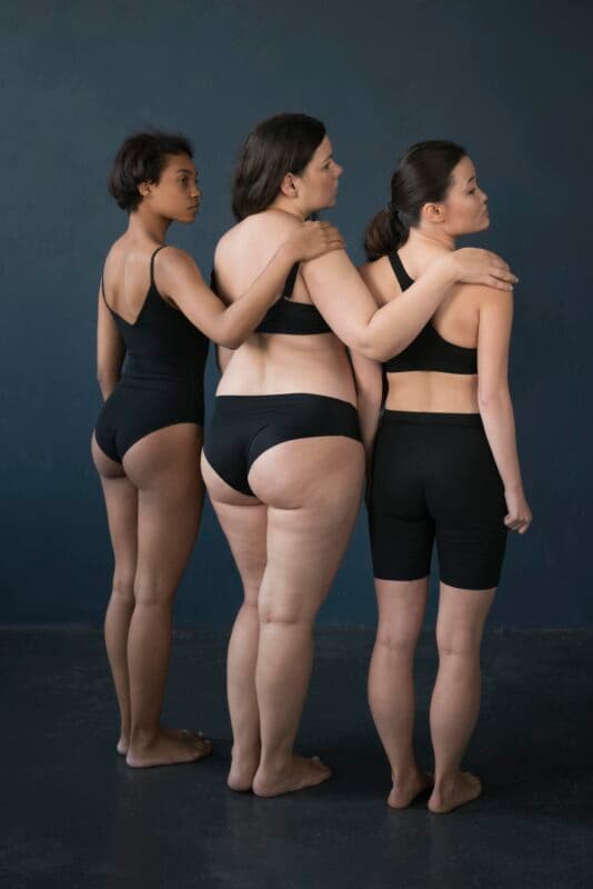Lipedema vai além da estética: doença crônica exige diagnóstico precoce e tratamento multidisciplinar