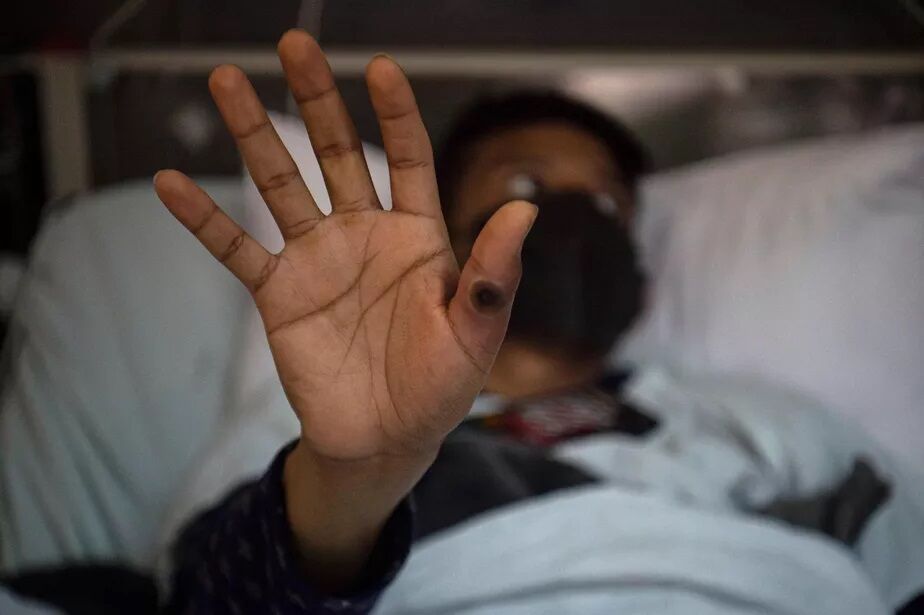 Homem testa positivo para varíola dos macacos, Covid-19 e HIV, em caso inédito Homem testa positivo para varíola dos macacos, Covid-19 e HIV, em caso inédito