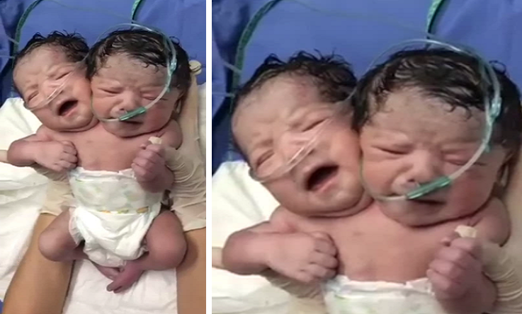 Morre bebê que nasceu com duas cabeças no México Morre bebê que nasceu com duas cabeças no México