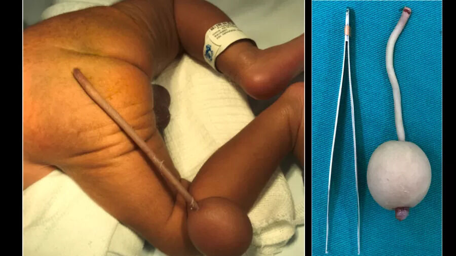 Caso raro: Bebê brasileiro nasce com cauda de 12 cm e bola de 4 cm na extremidade Caso raro: Bebê brasileiro nasce com cauda de 12 cm e bola de 4 cm na extremidade