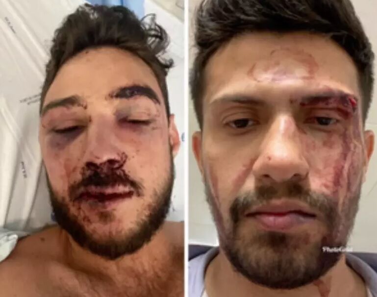 Casal gay de brasileiros é espancado em boate de Portugal: "Me torturaram" Casal gay de brasileiros é espancado em boate de Portugal: "Me torturaram"