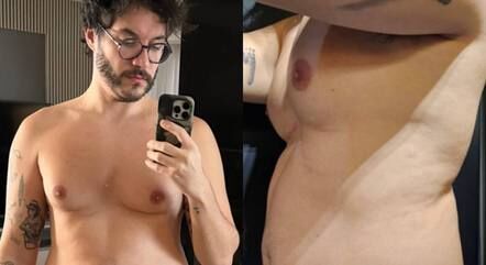 Entenda o que é a ginecomastia, desequilíbrio hormonal de Eliezer que faz as mamas crescerem