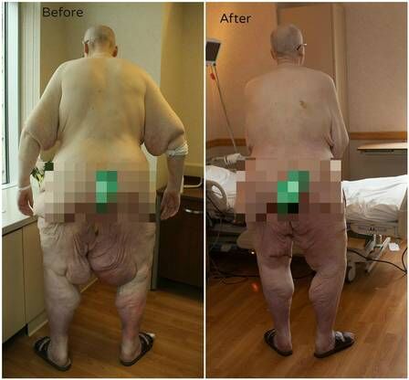Ex-mais gordo do mundo divulga vídeo com os primeiros passos após cirurgia Ex-mais gordo do mundo divulga vídeo com os primeiros passos após cirurgia