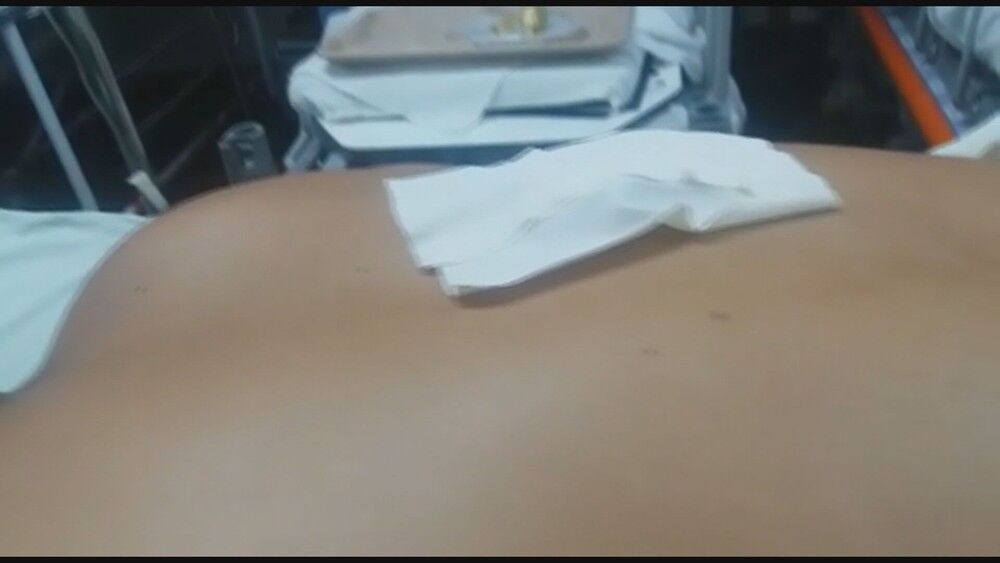 Paciente com faca cravada nas costas passa por cirurgia após 44 horas de espera na rede pública Paciente com faca cravada nas costas passa por cirurgia após 44 horas de espera na rede pública