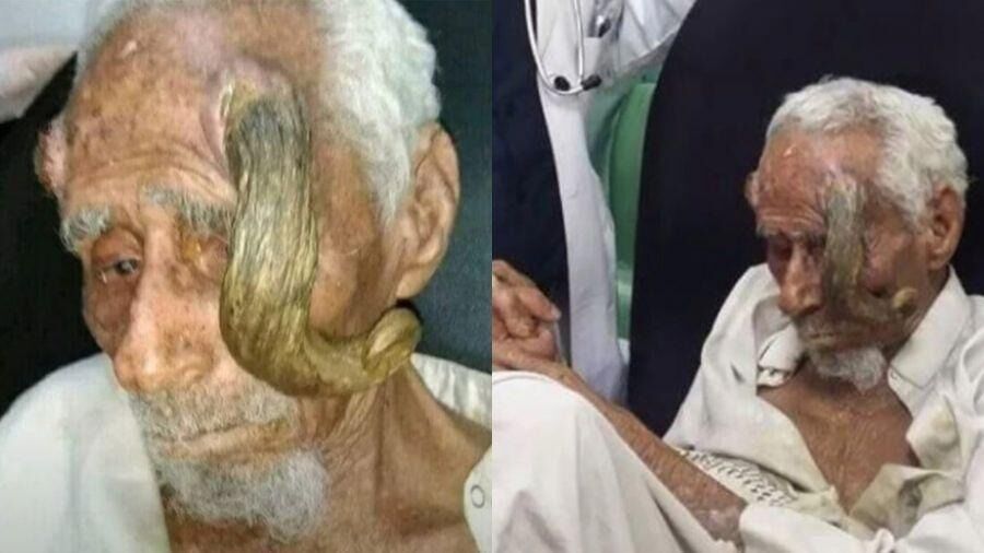 Homem que teria 140 anos morre após cirurgia para retirar 'chifres' Homem que teria 140 anos morre após cirurgia para retirar 'chifres'