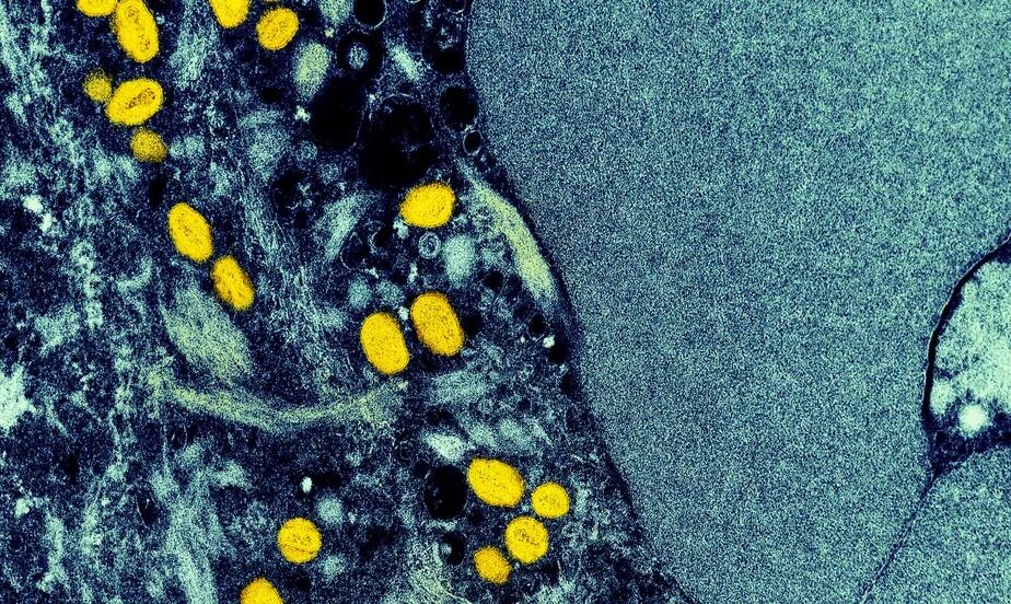 Monkeypox: Paraíba atualiza definição de caso suspeito e investiga três notificações Monkeypox: Paraíba atualiza definição de caso suspeito e investiga três notificações