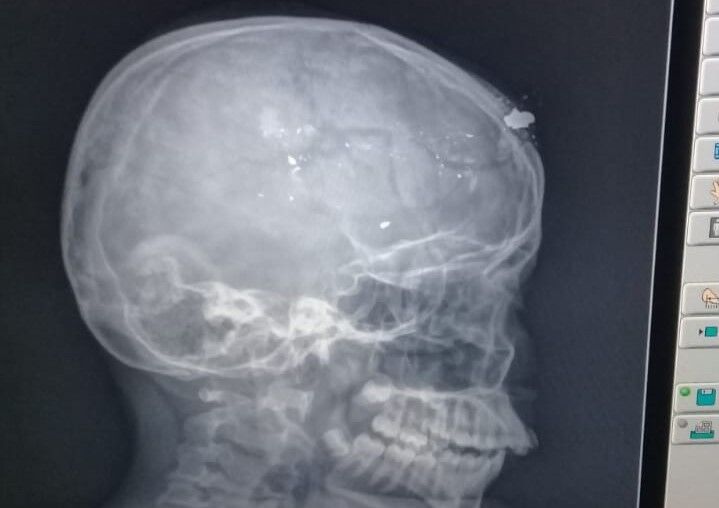 Criança atingida com tiro na cabeça em Catolé do Rocha teve fratura e afundamento do crânio Criança atingida com tiro na cabeça em Catolé do Rocha teve fratura e afundamento do crânio