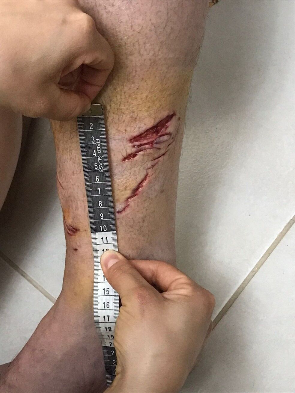 Turista francês foi mordido por tubarão em Ubatuba, confirmam pesquisadores Turista francês foi mordido por tubarão em Ubatuba, confirmam pesquisadores