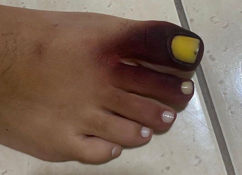 Piolho-de-cobra: animal pode deixar pele roxa, mas não é perigoso; veja em 5 pontos Piolho-de-cobra: animal pode deixar pele roxa, mas não é perigoso; veja em 5 pontos