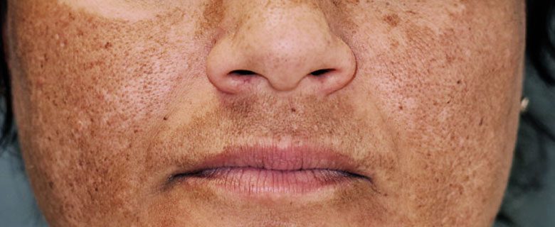 Melasma: 8 alimentos com compostos bioativos e ação fotoprotetora As inovações no tratamento do melasma trazem uma nova esperança para aqueles que enfrentam essa condição